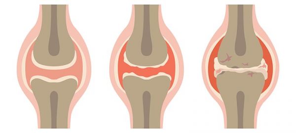 i sintomi dell’osteoartrite