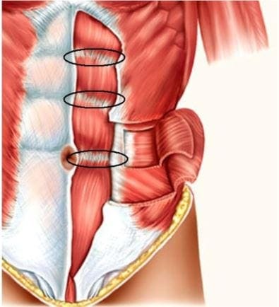 intersezioni tendinee - muscoli addominali